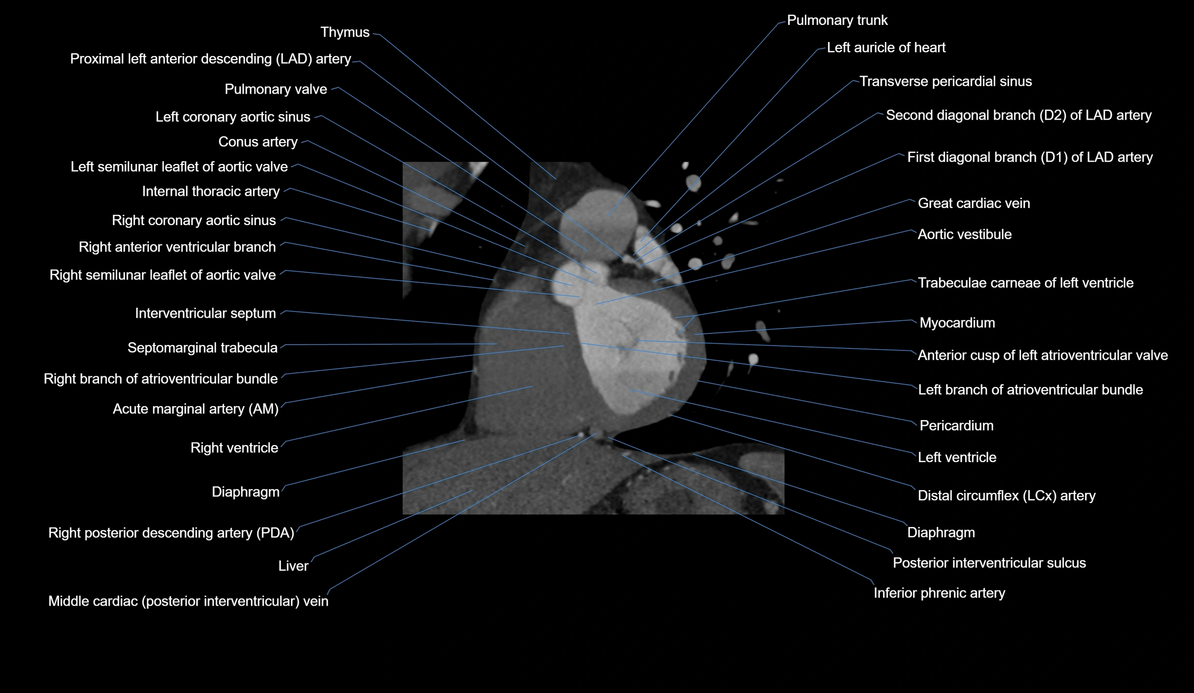 CT heart (coronary angiogram) short axis view  cross sectional anatomy labelled radiology image-00025.webp
